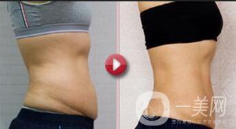 腹壁整形手術(shù)多少錢(qián)