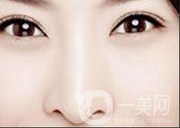 駝峰鼻整容,矯正駝峰鼻方法,駝峰鼻整容注意事項