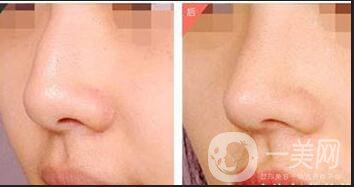 駝峰鼻整容,矯正駝峰鼻方法,駝峰鼻整容注意事項