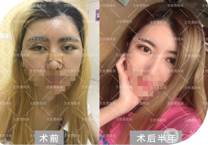 北京雙眼皮修復