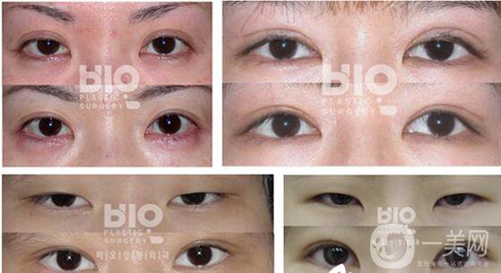 北京雙眼皮修復