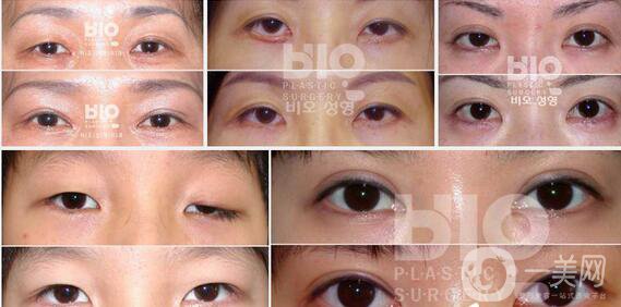 北京雙眼皮修復