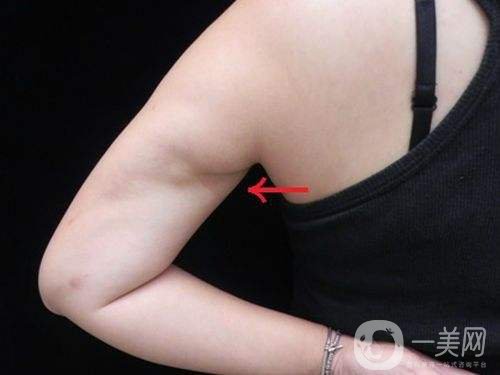 環(huán)形吸脂減肥有危害嗎 吸脂后需要注意哪些問題