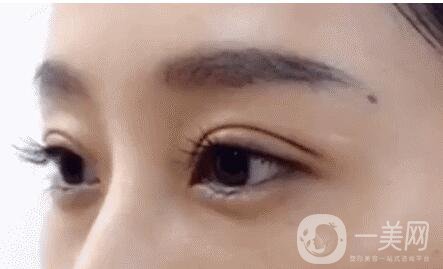 北京雙眼皮價格是多少