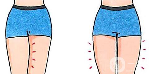 360度環(huán)形吸脂