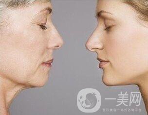 除皺的方式有哪些？