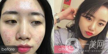 什么是囊性痤瘡?是什么引起了囊性痤瘡?