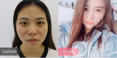 *手術恢復多久？多久可以拆線？