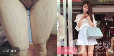 韓式共振吸脂減肥