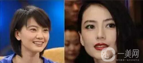 鼻翼過(guò)寬整容