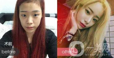 鼻翼過(guò)寬整容