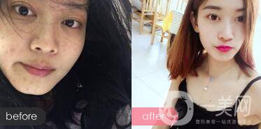 果酸祛痘*果嗎 果酸祛痘有什么好處？