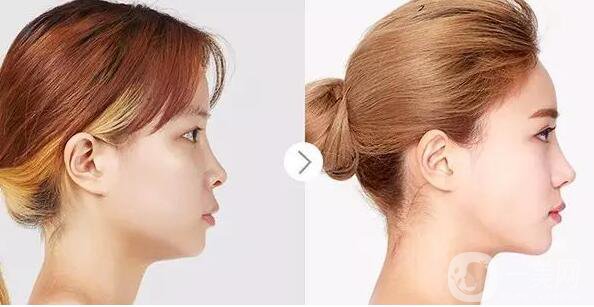 硅膠隆鼻材料的優(yōu)勢(shì)有哪些