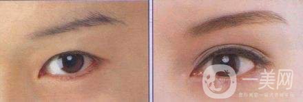 開外眼角前后圖片