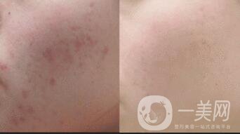 黑臉娃娃去痘印