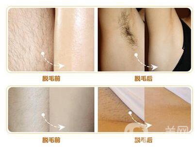 什么是激光脫毛？激光脫毛的優(yōu)勢有哪些？