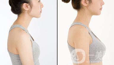 自體脂肪注射隆胸術(shù)需要注射幾次呢