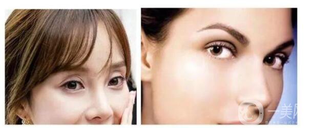 歐式雙眼皮手術(shù)適合哪些人呀 多少錢(qián)