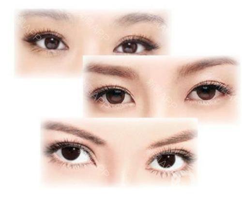 歐式雙眼皮手術(shù)適合哪些人呀 多少錢(qián)
