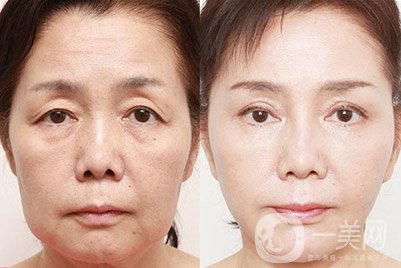 打膠原蛋白去皺針過程分析介紹