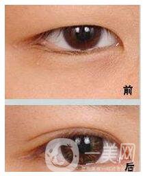 割雙眼皮多少錢(qián)合適 影響價(jià)格的因素有哪些
