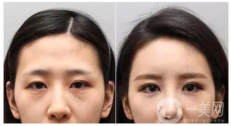 成都打去皺紋針多少錢呢