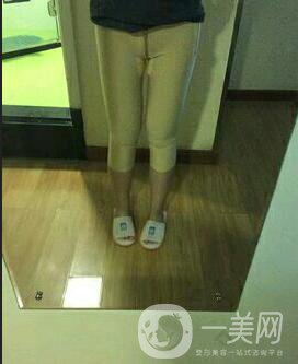 水動力吸脂親身經(jīng)歷