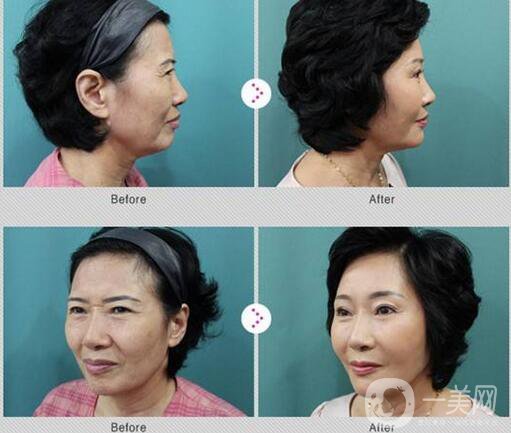 拉皮手術(shù)十年后的情況會(huì)是怎樣的