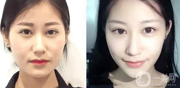 在成都注射*貴嗎 需要多少錢(qián)