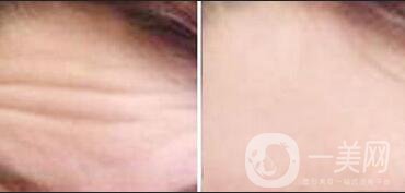 改良抬頭紋多少錢