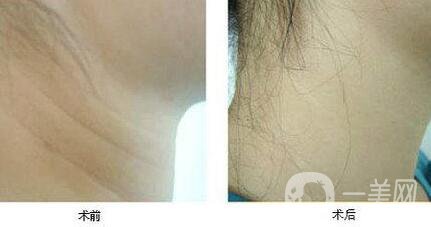 頸紋該怎么消除