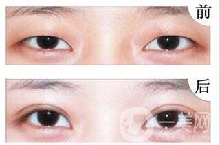 歐式雙眼皮多少錢