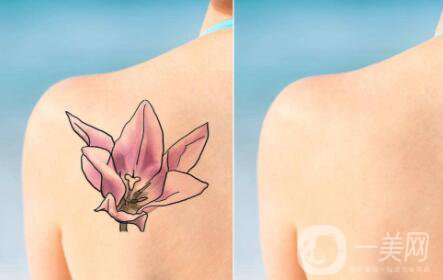 紋身去除**的4種方法 