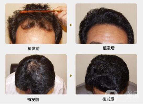 什么是植發(fā)手術(shù)？脫發(fā)的主要原因？