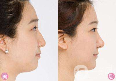 駝峰鼻整形后有后遺癥嗎 注意事項有哪些