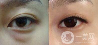 內(nèi)吸去眼袋價(jià)格