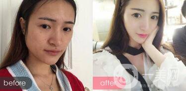 下頜角截骨術(shù)后護(hù)理