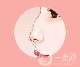 駝峰鼻矯正方法有哪些呢