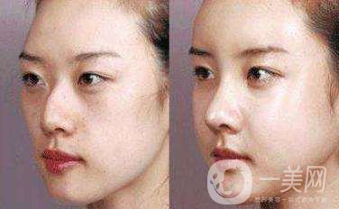 駝峰鼻矯正方法有哪些呢