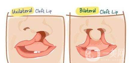 唇腭裂修復(fù)手術(shù)的成因與糾正 我的孩子什么時(shí)候應(yīng)該做手術(shù)