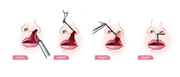 唇腭裂修復(fù)手術(shù)的成因與糾正 我的孩子什么時(shí)候應(yīng)該做手術(shù)