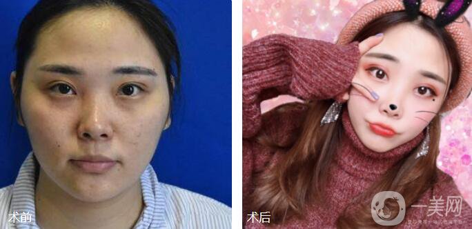 磨顴骨前后照片分享介紹 真人案例 33天就看見*果！