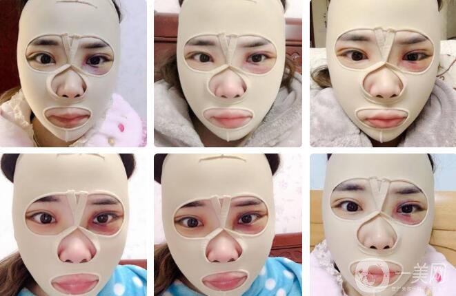 磨顴骨前后照片分享介紹 真人案例 33天就看見*果！