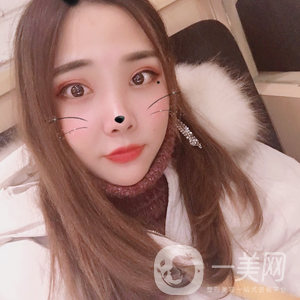 磨顴骨前后照片分享介紹 真人案例 33天就看見*果！