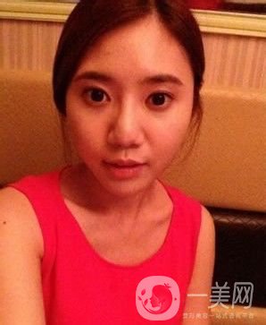 去頰脂墊*果圖賞析