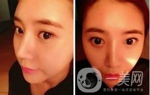 去頰脂墊*果圖賞析