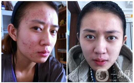 微針可以去痘坑嗎?當(dāng)痘坑痘印遇上【微針】