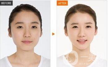 面部光纖溶脂*果