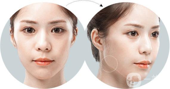 削骨瘦臉價(jià)格