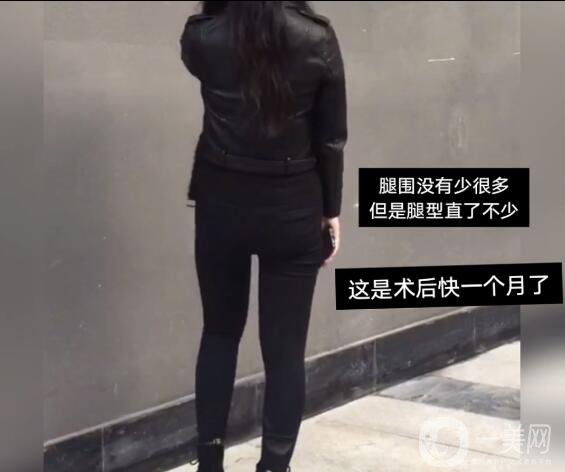 大腿環(huán)吸抽脂